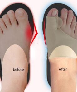 Orthopedic Bunion Corrector