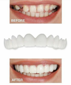 🔥50% OFF🔥 Magic Smile Teeth Brace 💝BUY 1 GET 1 FREE!