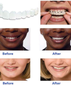 🔥50% OFF🔥 Magic Smile Teeth Brace 💝BUY 1 GET 1 FREE!