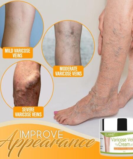 Organic Varicose Vein Healing Cream