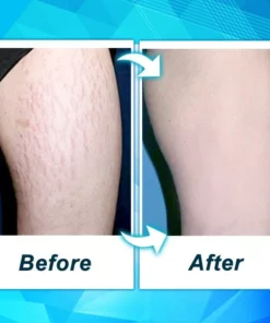 Dr. Removal™ Stretch Mark Firming Cream