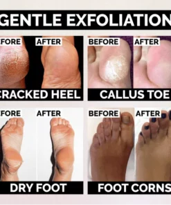 Anti-Fungal Peeling Foot Soak