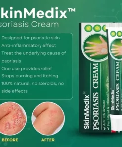 SKINMEDIX™PSORIASIS CREAM