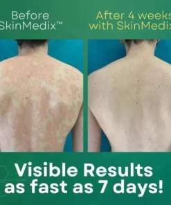 SKINMEDIX™PSORIASIS CREAM