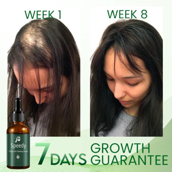 Speedy 7Days Hair Growing Serum