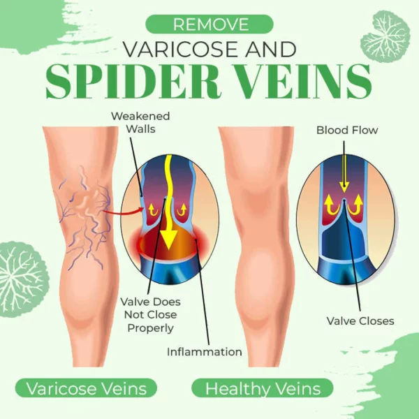 VeinoAway Varicose-Veins Treatment Soap