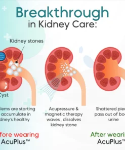 AcuPlus™ Kidney Care Point Clip