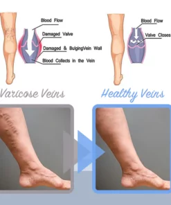 MEDix™ Varicose Veins Spray