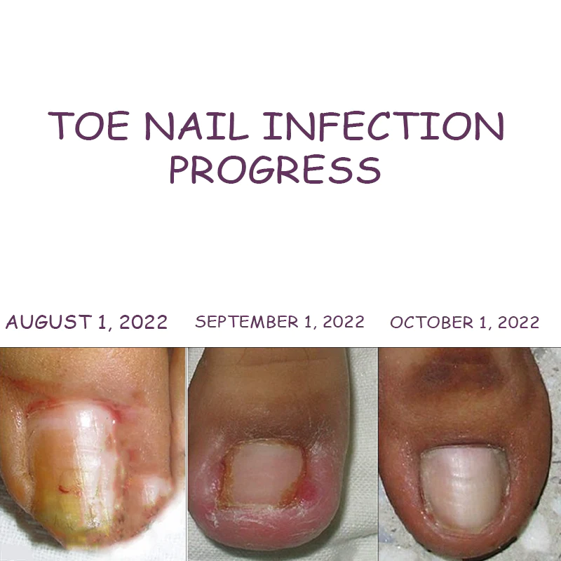 Ingrown toenails - treatment, symptoms, causes and prevention