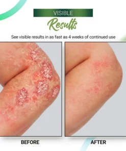 Psoriasis Relieving Cream