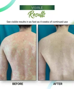 Psoriasis Relieving Cream