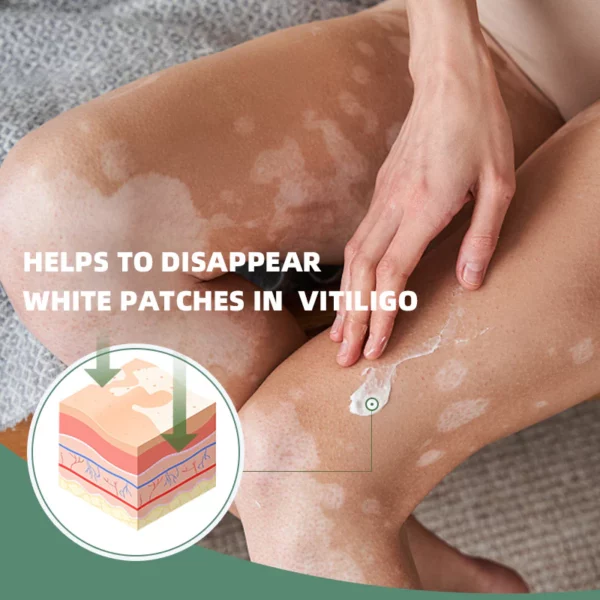 Shinyme Vitiligo Skin Repair Cream