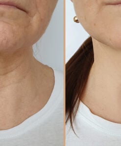 ATTDX PerfectNeck CollagenFirming LaceMask