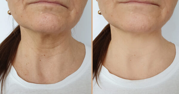 ATTDX PerfectNeck CollagenFirming LaceMask