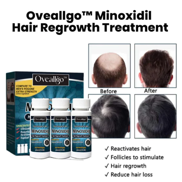 Oveallgo™ Minoxidil Hair Regrowth Treatment