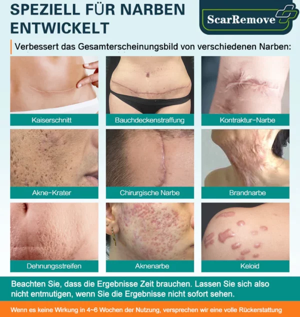 ScarRemove™ Fortgeschrittenes Narbenspray für alle Arten von Narben - Image 2