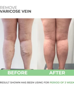 Wormwood Varicose Veins Care Soap