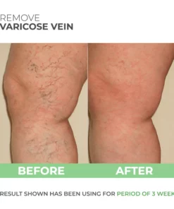 Wormwood Varicose Veins Care Soap