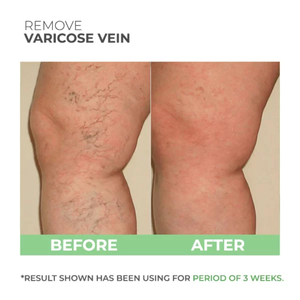 Wormwood Varicose Veins Care Soap