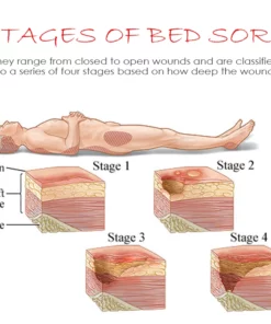 ATTDX BedSores FastHealing TreatmentCream