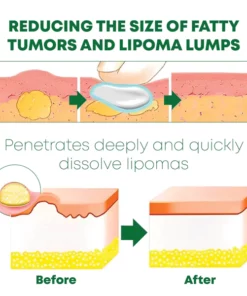 ATTDX LipomaRemoval Herbal Cream