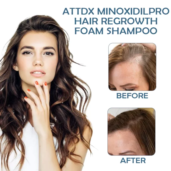 ATTDX MinoxidilPro HairRegrowth FoamShampoo