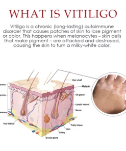 ATTDX VitiligoRemoval Relief Spray