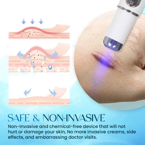 ScarErase™ UV Phototherapy Scar Removal Pen - Image 4