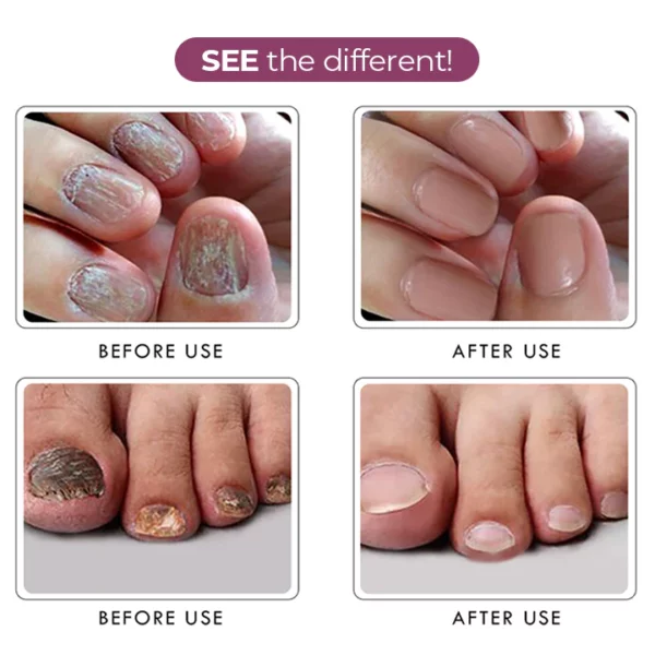 RxCARE™ Ginger Nail Treatment Essence