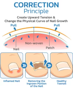 ToenailHeal Paronychia Relief Patch