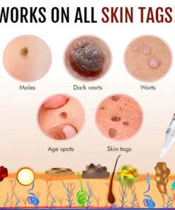 Wipe™ Tags & Moles Remover