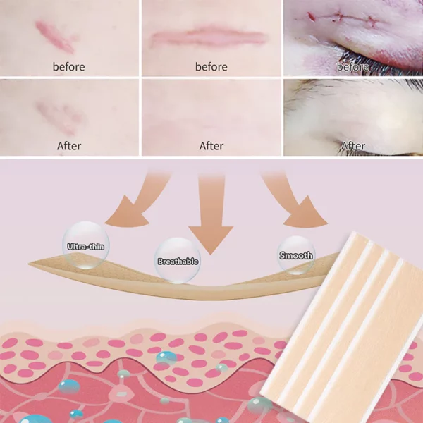 BIOCLEAR™ Silicone Scar Reduction Sheets