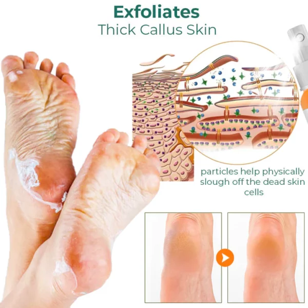 CC™ Foot Callus Removal Spray