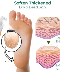 CC™ Foot Callus Removal Spray