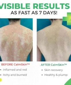 CalmSkin™ Psoriasis Defense Body Wash