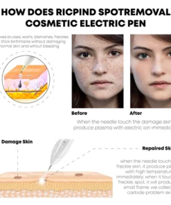 Ricpind SpotRemoval Cosmetic Electric Pen