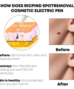 Ricpind SpotRemoval Cosmetic Electric Pen