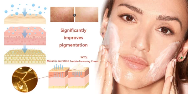 SKTQL™ Freckle-Removing Cream