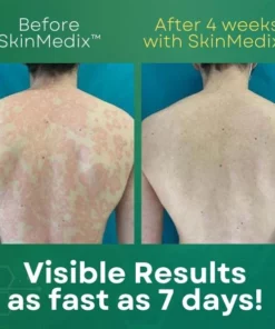 SkinMedix™ Psoriasis Cream