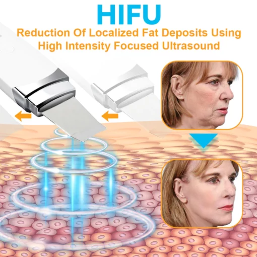 CC™ HIFU Face Lifting Instrument - Image 3