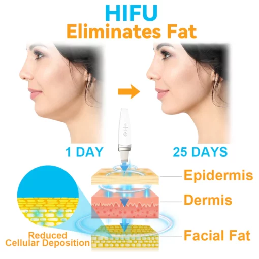 CC™ HIFU Face Lifting Instrument - Image 6