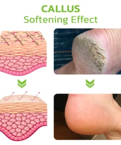 CC™ IHerbal Foot Callus And Corns Removal Soak