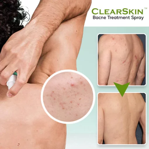 ClearSkin™ Bacne Treatment Spray - Image 5