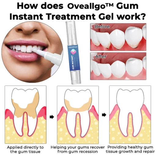 Oveallgo™ Gum Instant Treatment Gel - Image 2