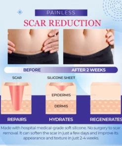 Ultracare™Medical Grade Silicone Scar Sheets