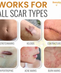 BeevHeal™ Scar Removal Spray