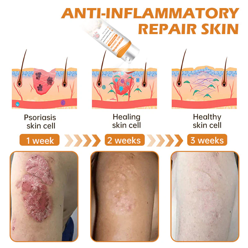 AQA™ PsoriaHeal 蜂毒牛皮癣治疗喷雾