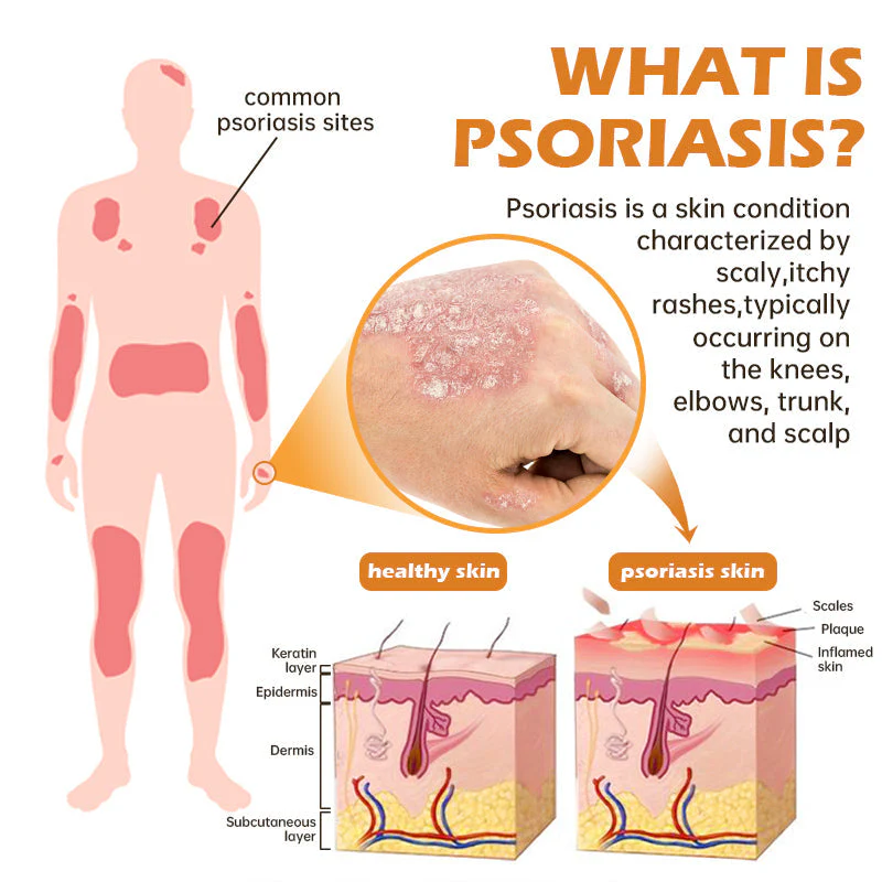 AQA™ PsoriaHeal 蜂毒牛皮癣治疗喷雾