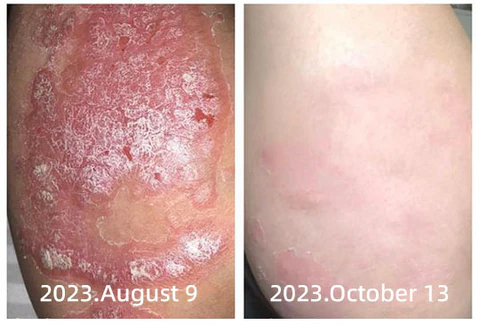 AQA™ New Zealand Bee Venom Psoriasis Treatment Cream(Suitable for all skin conditions)