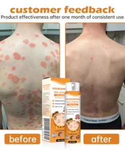 AQA™ PsoriaHeal Bee Venom Psoriasis Treatment Spray